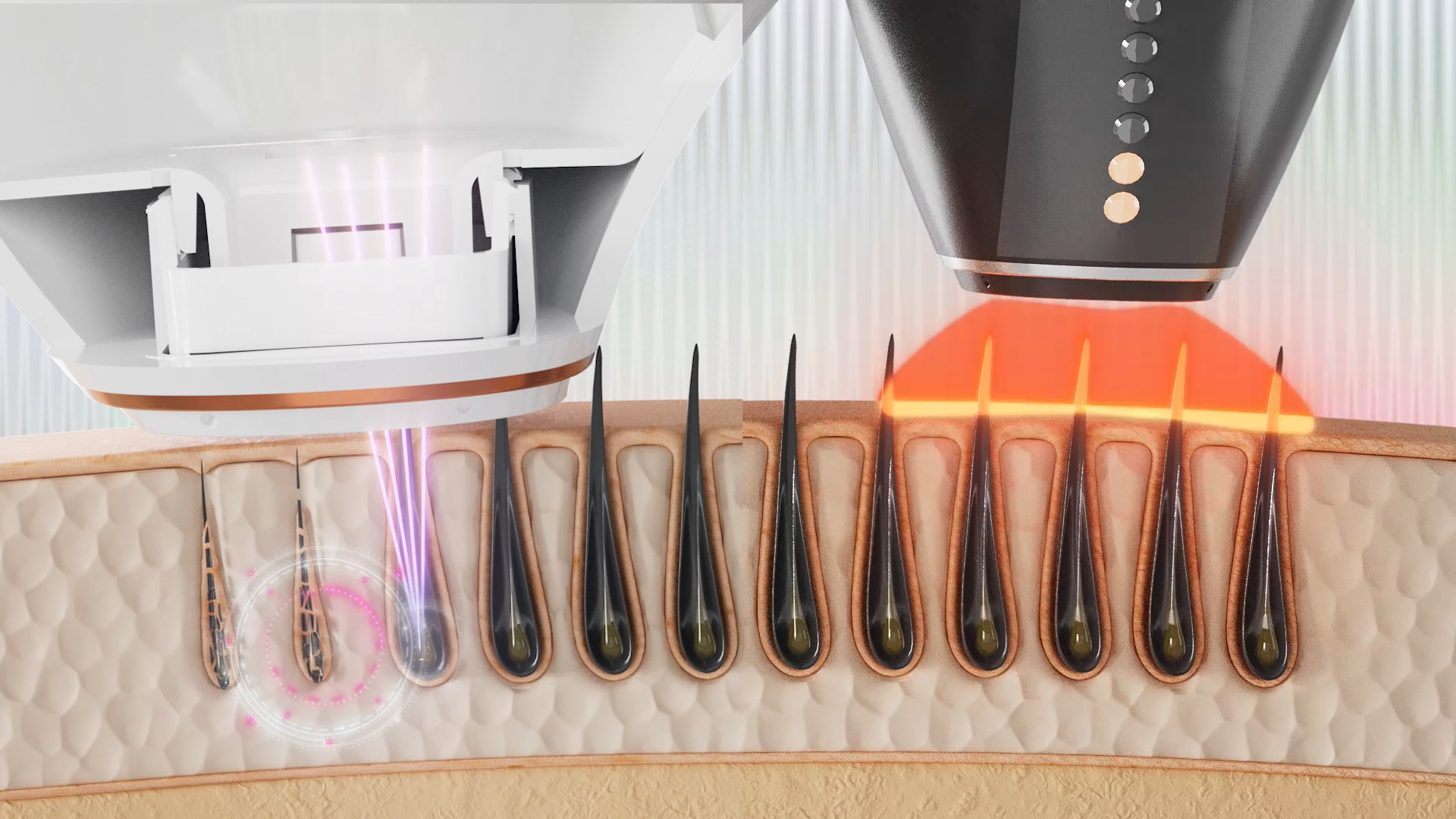 IPL vs Laser Hair Removal