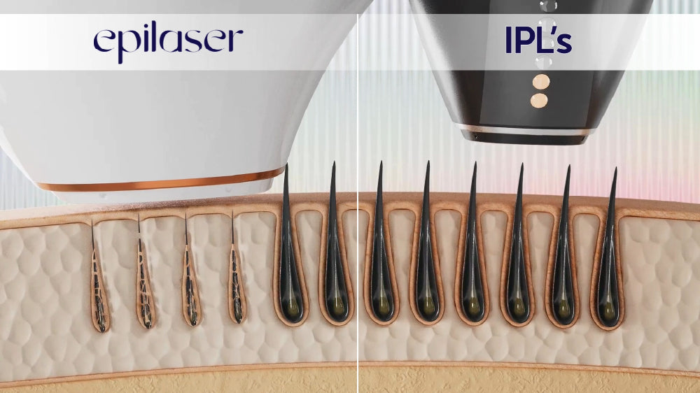 Load video: Epilaser vs. IPL video
